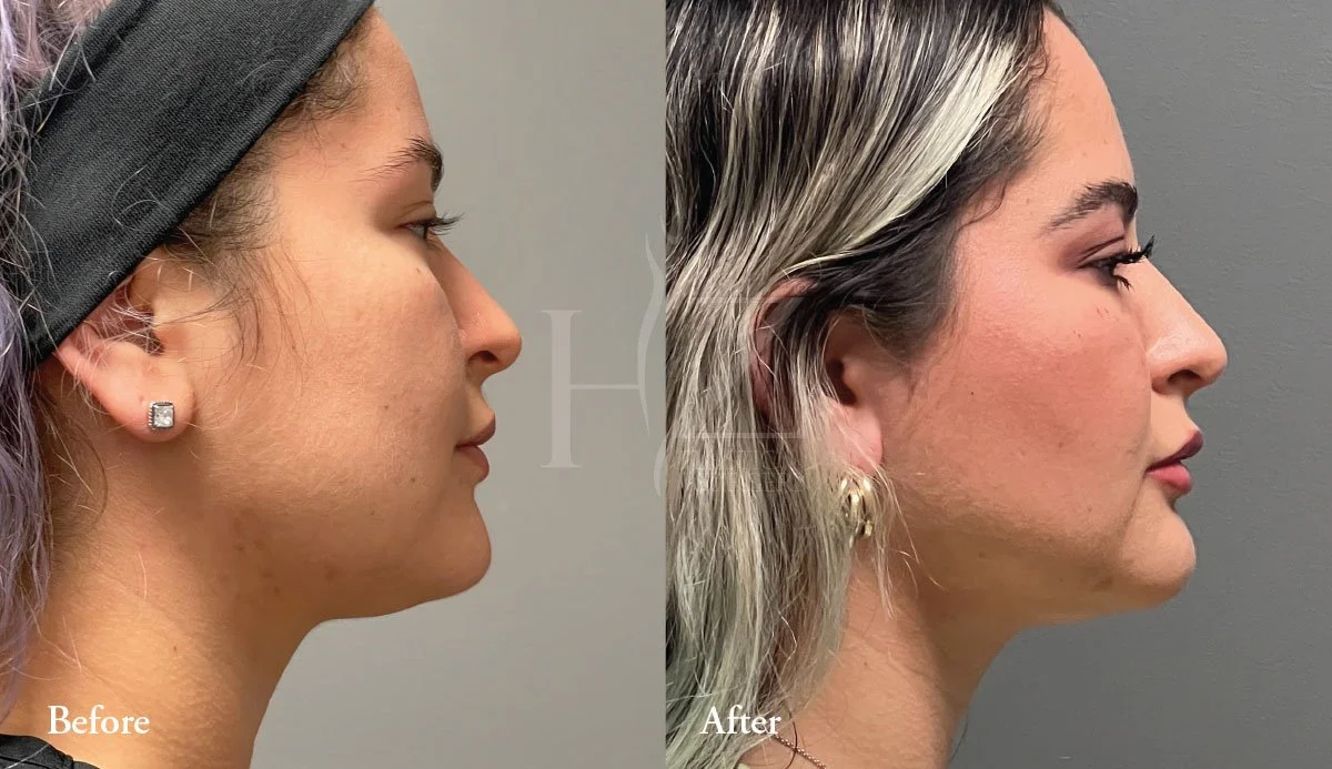 Buccal Fat Removal In Orlando HZ Plastic Surgery